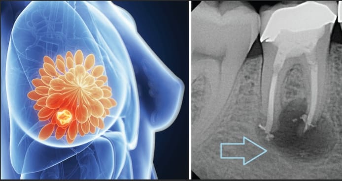 Root Canals and Cancer: Setting the Record Straight Evidence-Based Care for the Public’s Best Interest