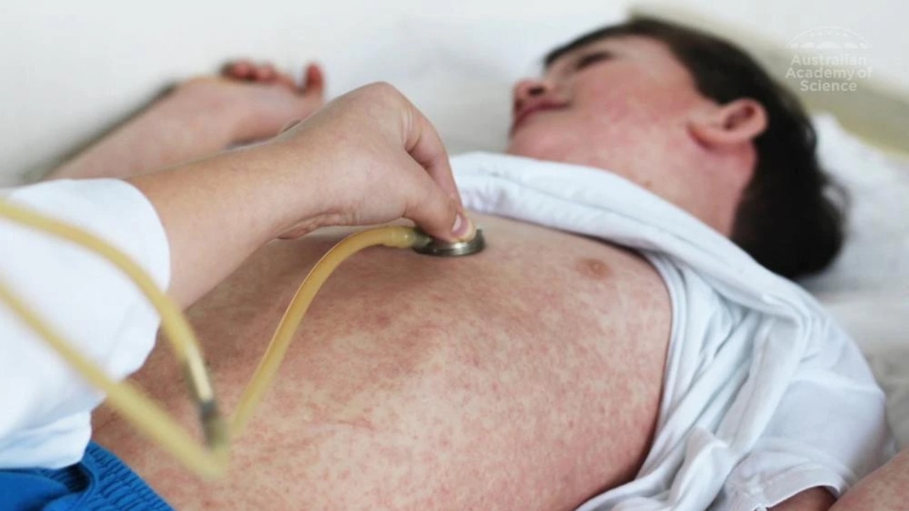 NSW Health issues measles alert after confirmed case linked to overseas traveller, multiple exposure sites listed